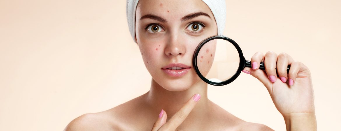 ACNE By Dr Steven Ang