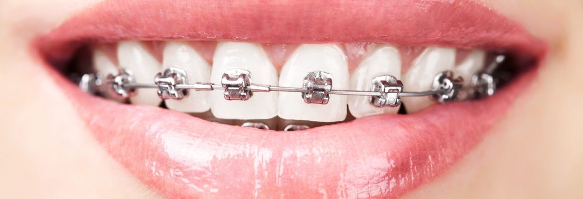 braces-by-dr-raymond-lim