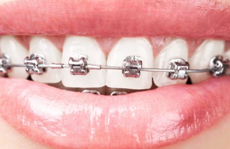 braces-by-dr-raymond-lim