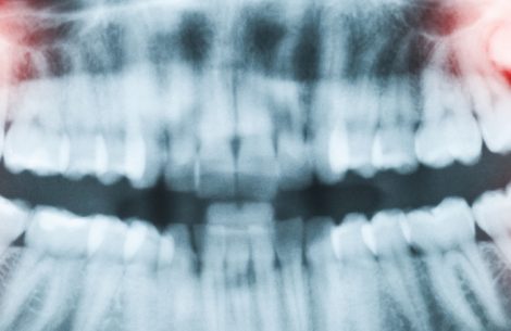 canine-teeth-by-dr-raymond-lim