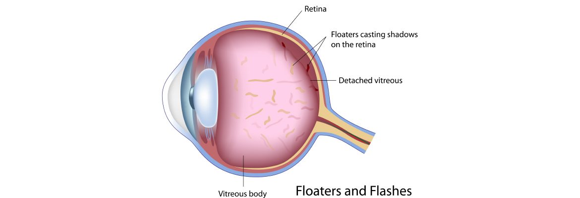floaters-possible-red-flag-symptoms-of-a-serious-eye-problem-by-dr-elaine-huang