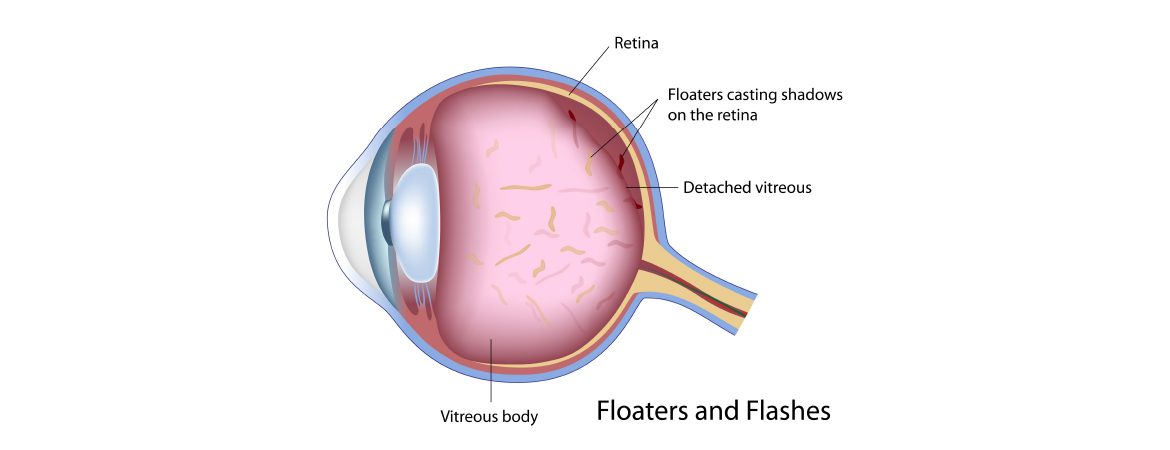 Floaters: Possible Red-Flag Symptoms of a Serious Eye Problem by Dr Elaine Huang