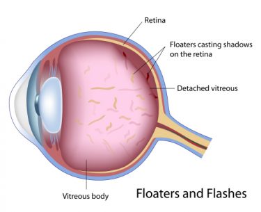 Floaters: Possible Red-Flag Symptoms of a Serious Eye Problem by Dr Elaine Huang
