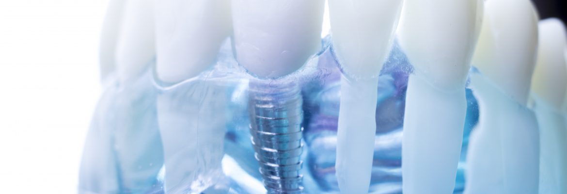 dr-raymond-lim-dentures-vs-implant