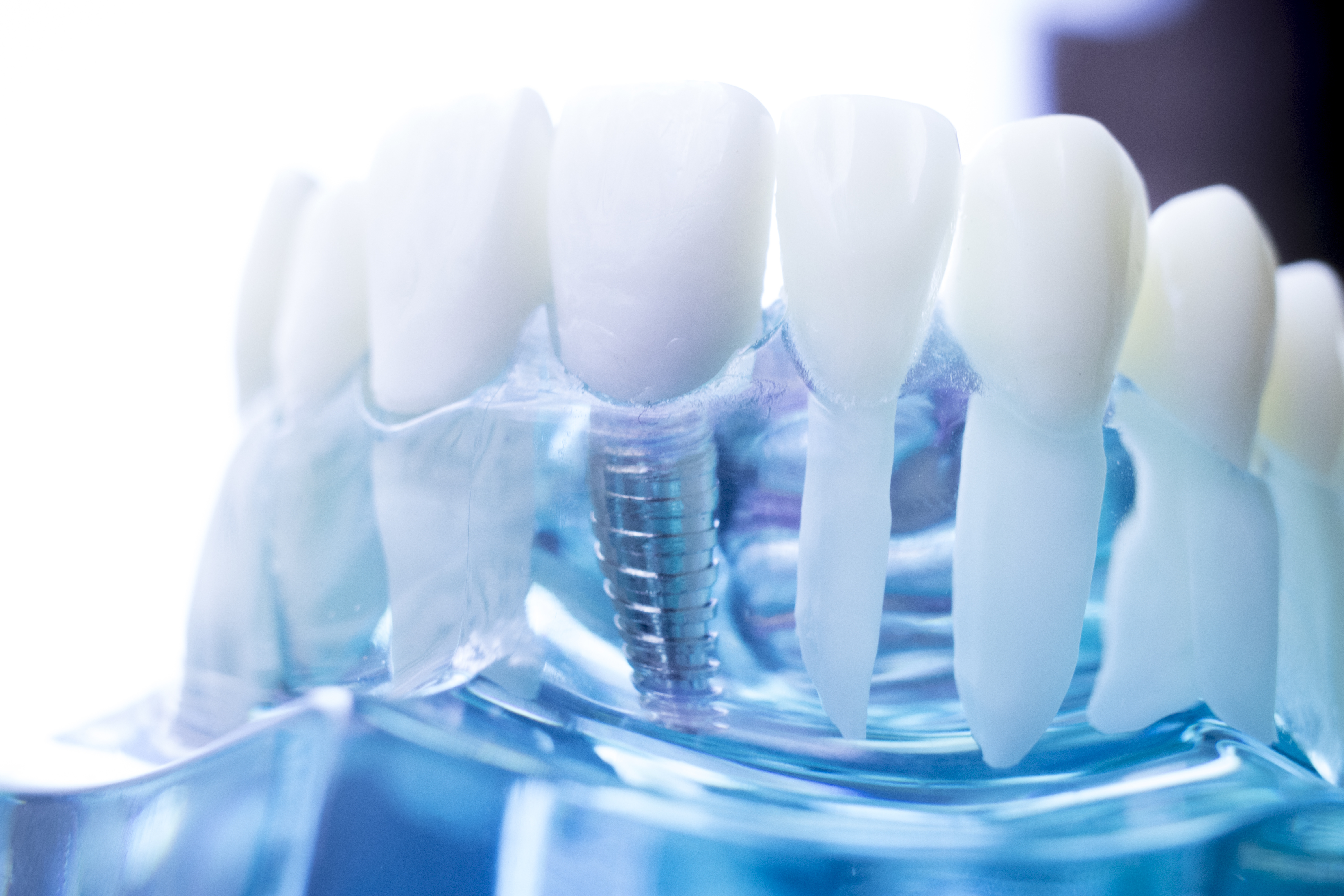 Dr Raymond Lim – Dentures vs Implant