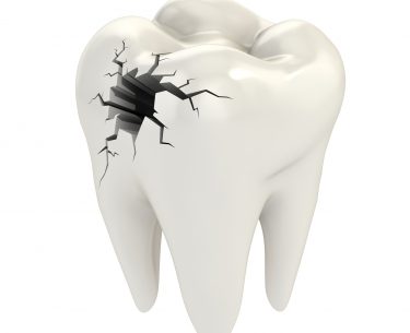 Dr Raymond Lim – Crack Tooth