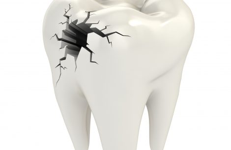 dr-raymond-lim-crack-tooth