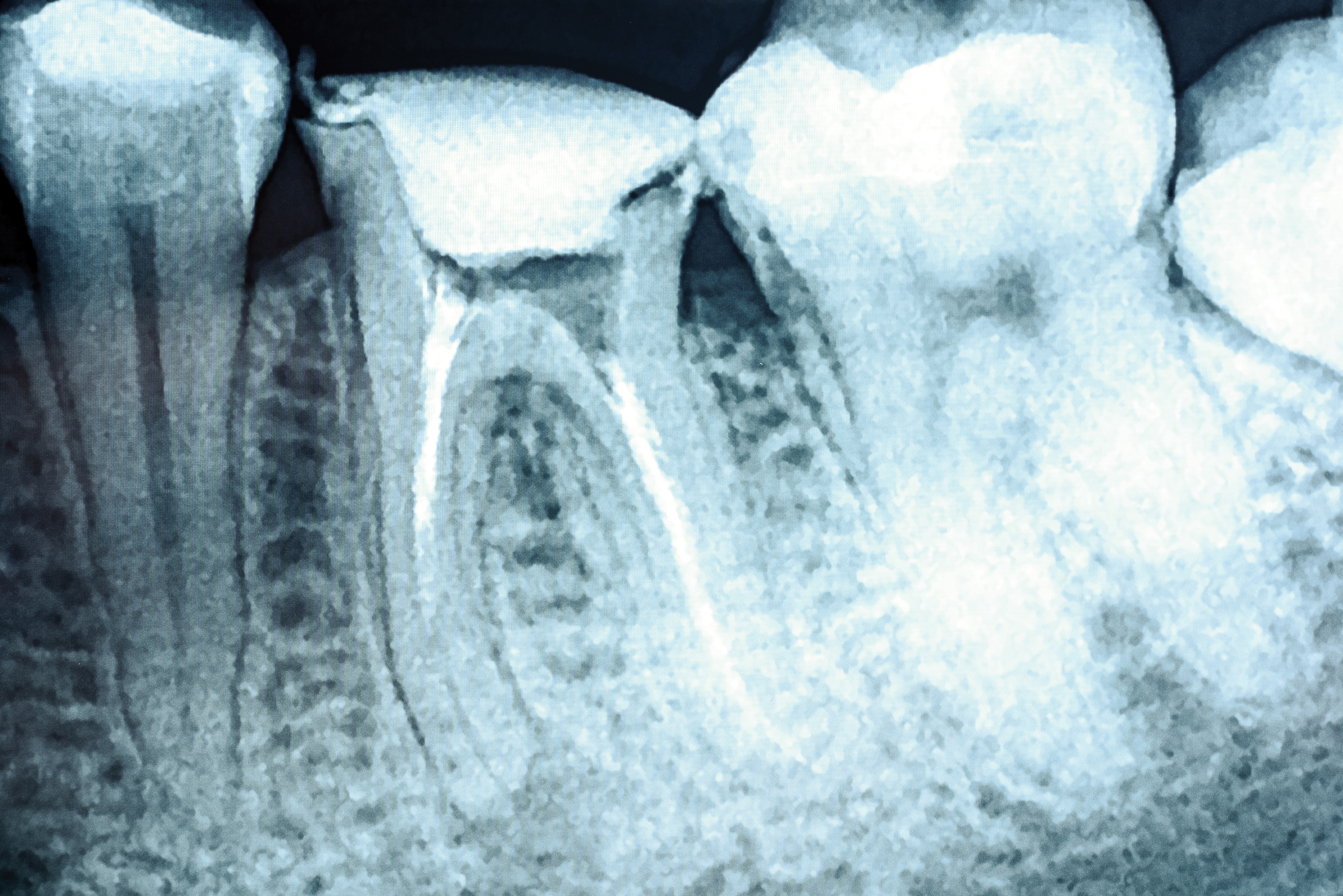 When Do You Need A Root Canal Treatment